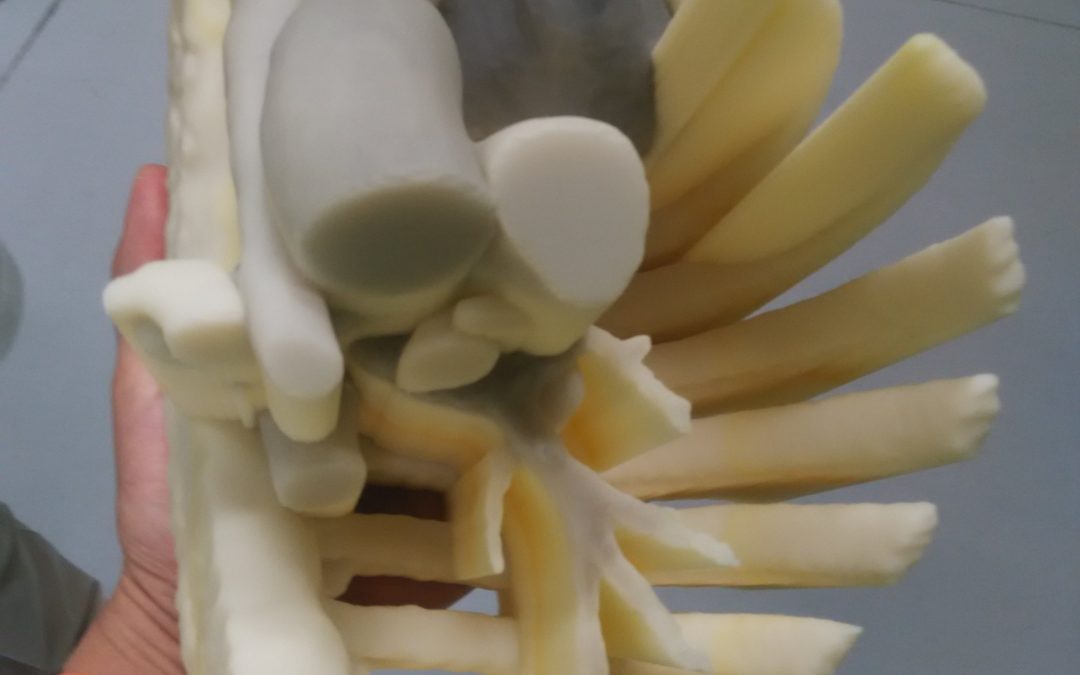 Andaltec fabrica un modelo 3D para facilitar la operación del tumor en el pecho de una niña