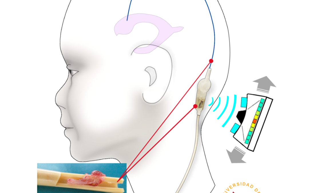 Desarrollan una nueva tecnología para prevenir obstrucciones en catéteres de pacientes con hidrocefalia